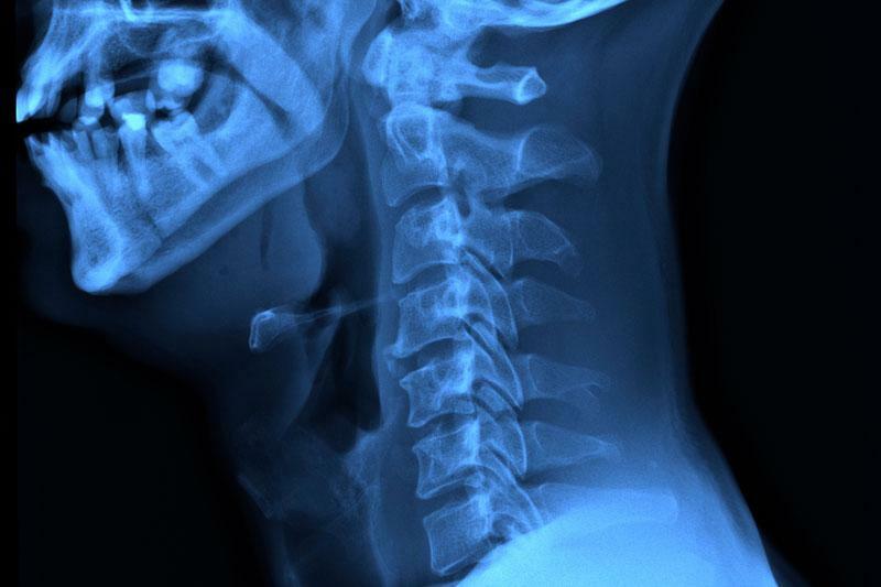 Рентген шейного отдела позвоночника - что показывают снимки