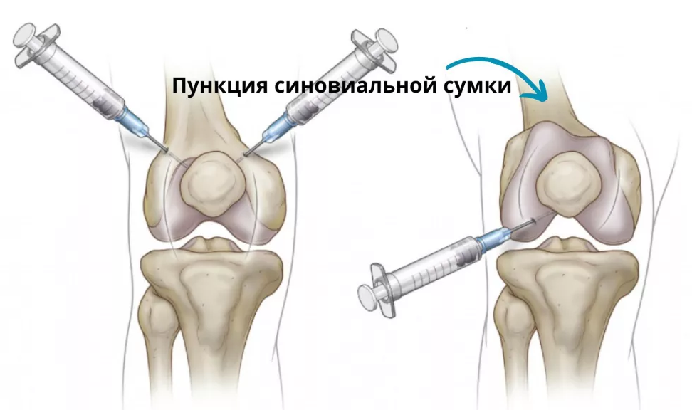 Пункция жидкости из коленного сустава.