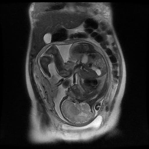 Снимок МРТ плода.