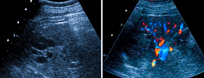 УЗДГ сосудов селезенки - снимки.