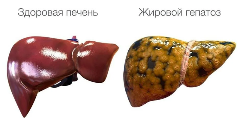 Сравнение нормальной печени с жировой печенью.