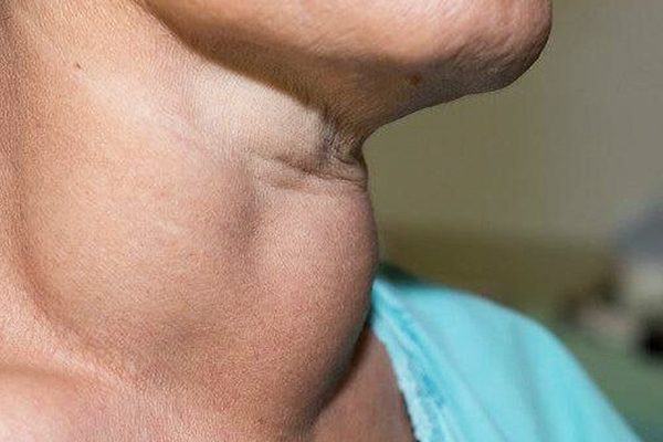 КТ щитовидной железы - противопоказания