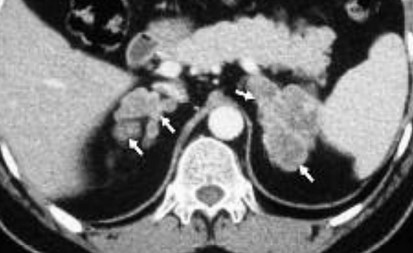 КТ надпочечников - снимки