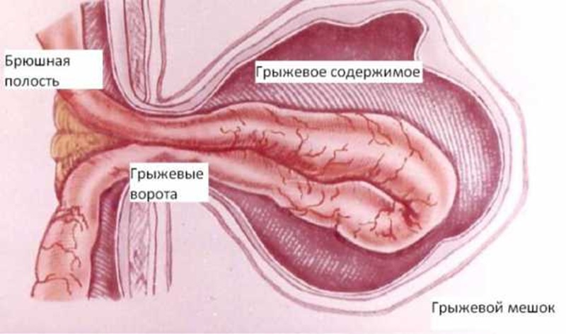 Содержимое грыжи живота.