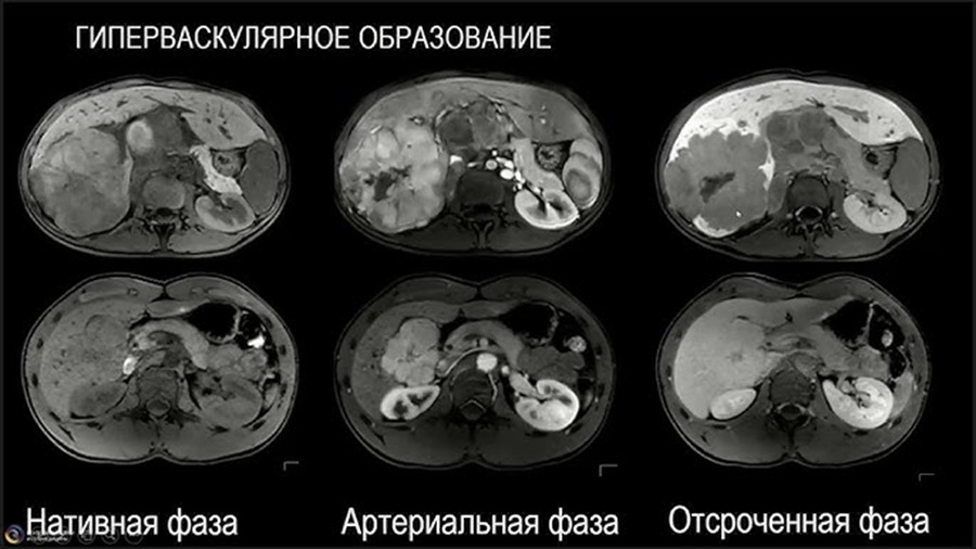Снимки МРТ печени с описанием.