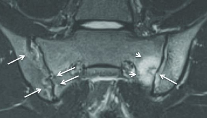 МРТ крестцово-подвздошных сочленений - снимки.
