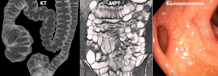 Сравнение снимков КТ, МРТ и колоноскопии кишечника