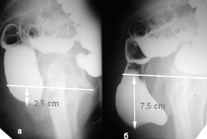 Проктография - расшифровка результатов