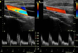 УЗИ сосудов шеи - что показывают снимки