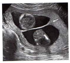 УЗИ многоплодной беременности во 2 триместре - снимки