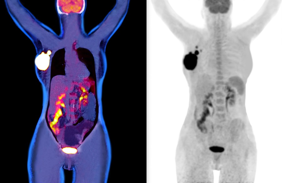 Рак молочной железы на ПЭТ-КТ