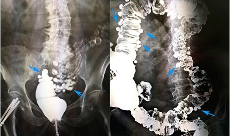 Проктография - что показывают снимки