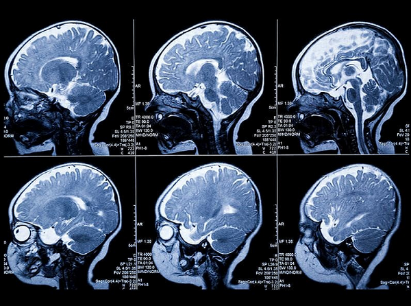 МРТ головного мозга ребенку при эпилепсии - снимки