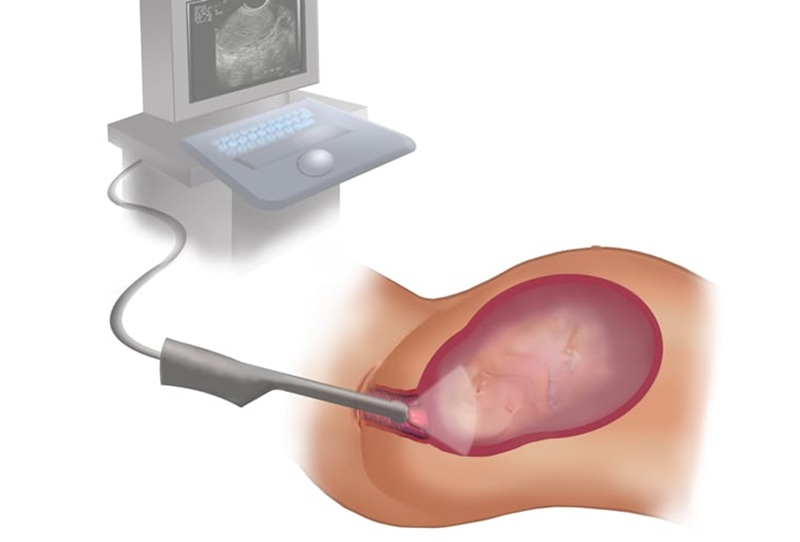 УЗИ шейки матки (Цервикометрия) - процедура проведения