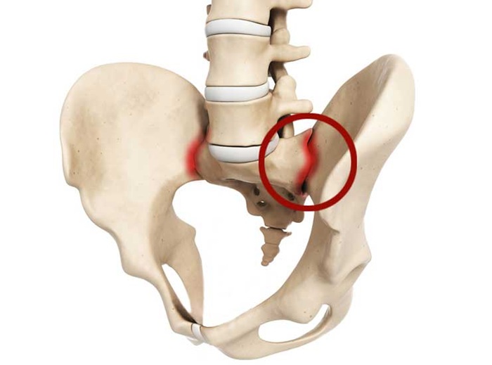 МРТ крестцово-подвздошного сочленения: диагностика