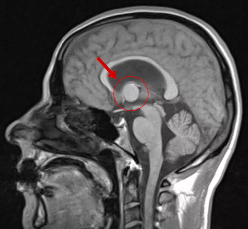 как выглядит киста головного мозга