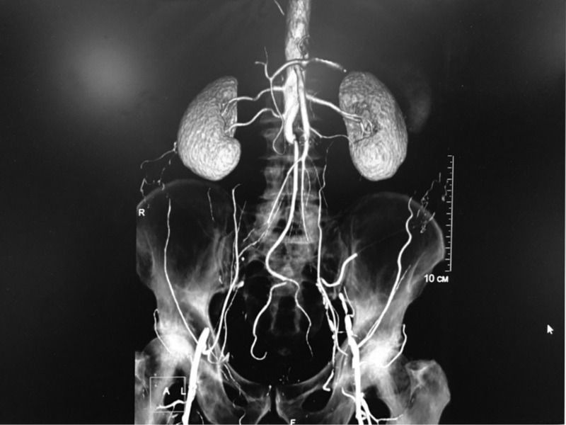 КТ-ангиография почечных артерий - что показывают снимки