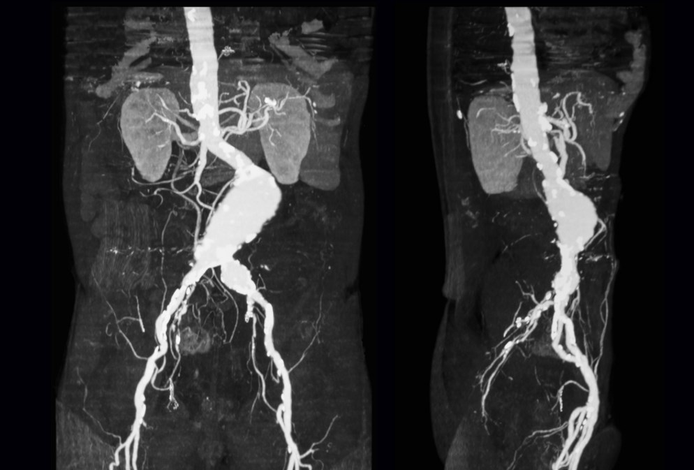 Снимок КТ брюшного отдела аорты в двух проекциях.