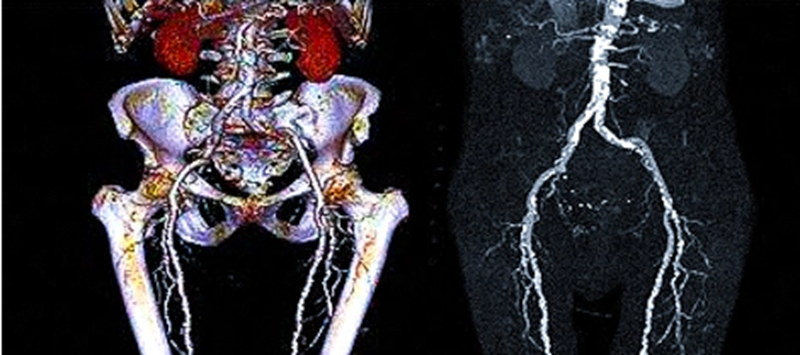 КТ-ангиография подвздошной артерии - что показывают снимки