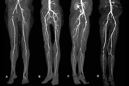 КТ сосудов нижних конечностей - что показывают снимки