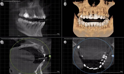 КТ челюсти - расшифровка результатов