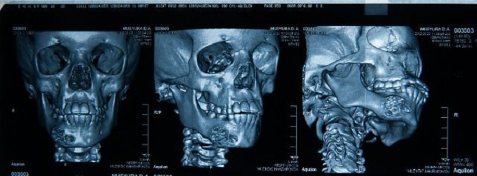 КТ костей лицевого черепа - снимки