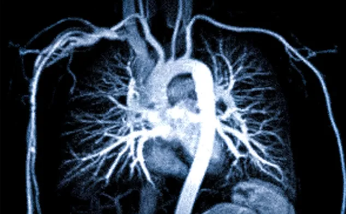 КТ грудной аорты и легочной артерии - снимки с контрастом