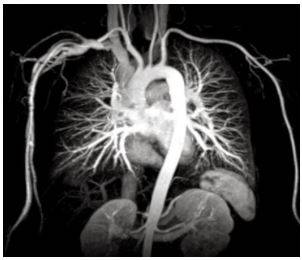 КТ грудной аорты и легочной артерии - снимки