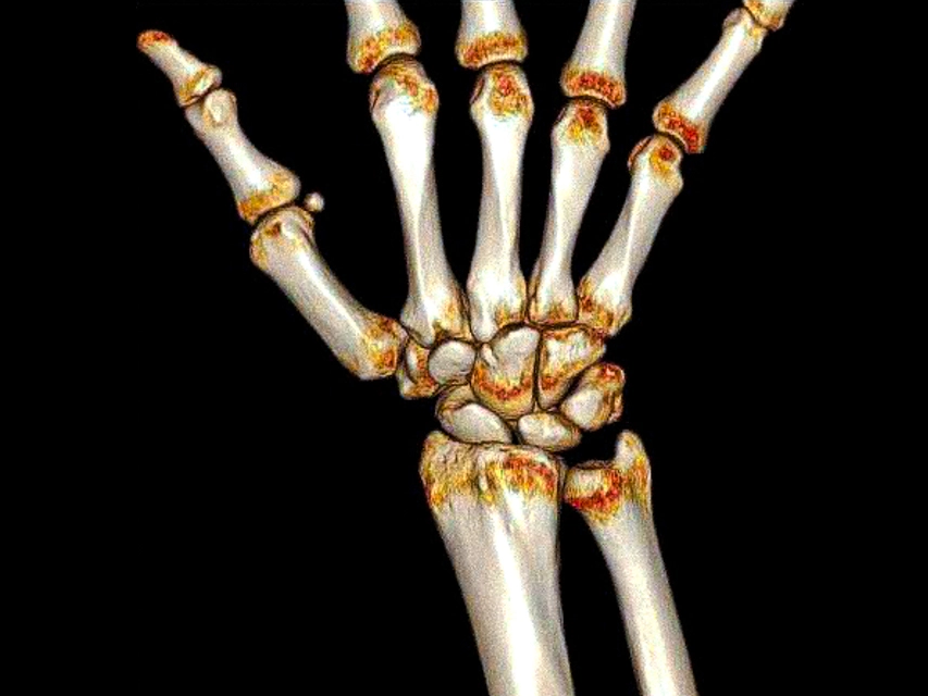 КТ лучезапястного сустава - снимки