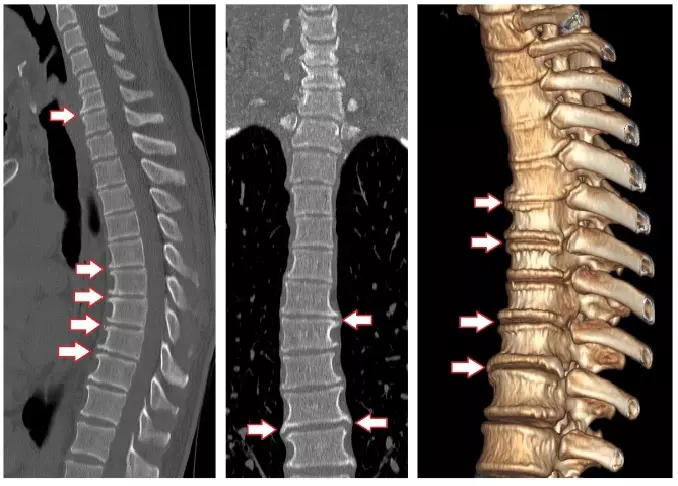Снимки КТ позвоночника в разных режимах