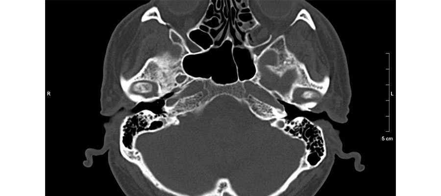 КТ височных костей - снимки