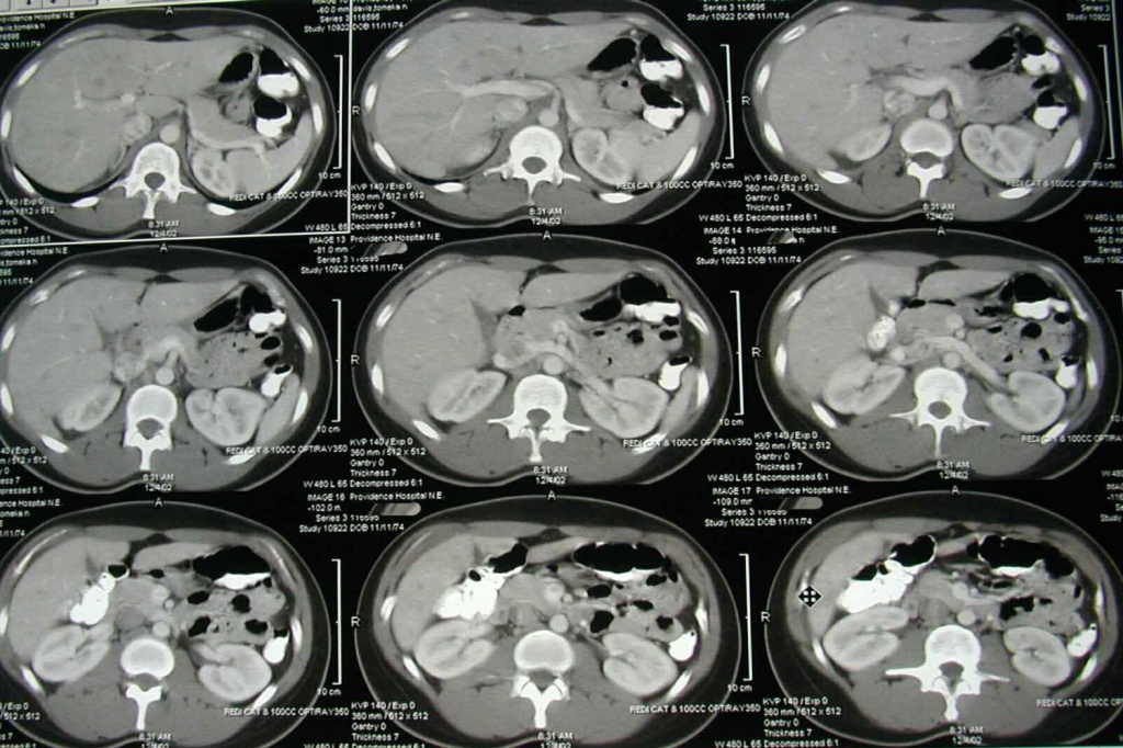 Снимки КТ органов брюшной полости