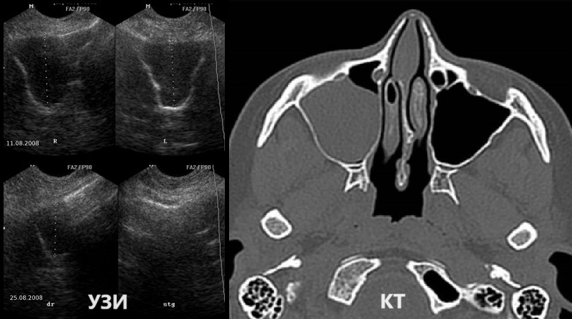 Сравнение снимков УЗИ и КТ придаточных пазух носа
