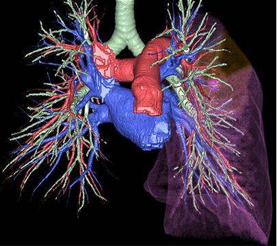 КТ-ангиография легочных артерий - диагностика