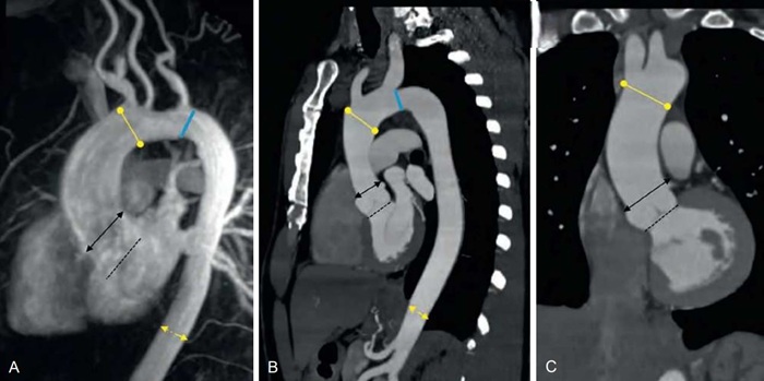 КТ-ангиография грудного отдела аорты и ее ветвей - снимки.