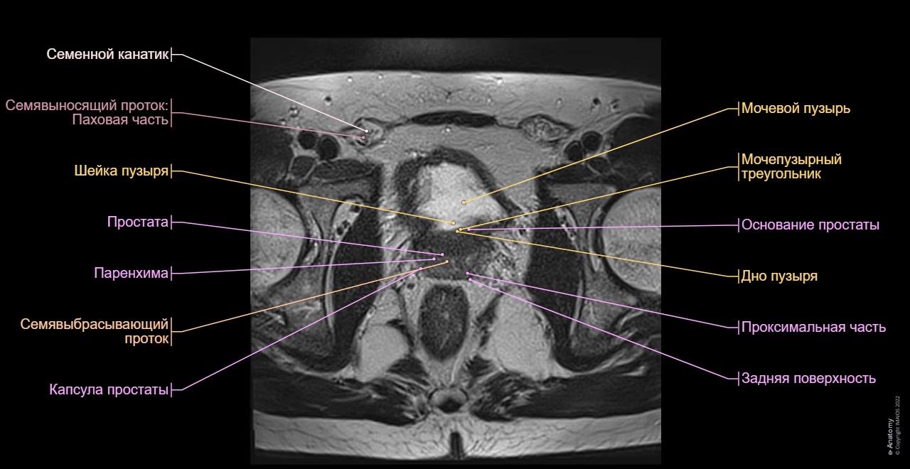МРТ органов малого таза мужчины - снимок с описанием