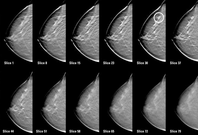 Рентген молочных желез (маммография) - что показывают снимки