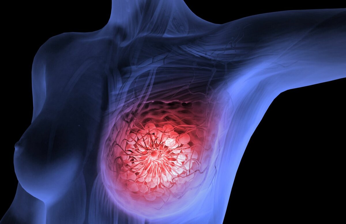 Рентген молочных желез (маммография) - описание диагностики