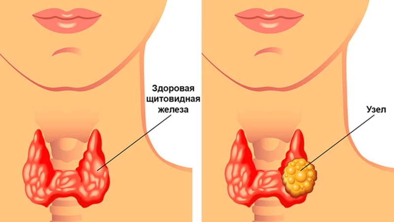 Узел щитовидной железы.