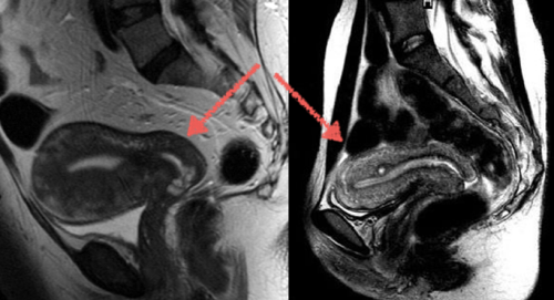 эндометриоз на снимках МРТ