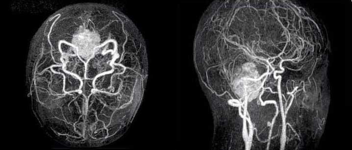 МР-ангиография головного мозга
