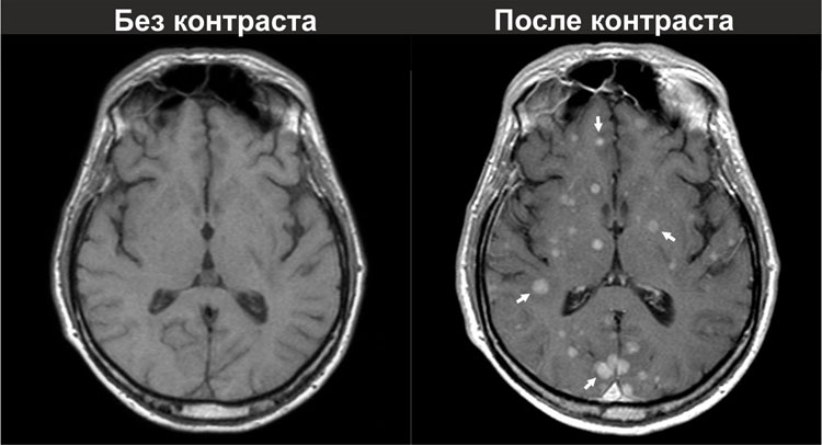 Сравнение МРТ головного мозга с контрастом и без