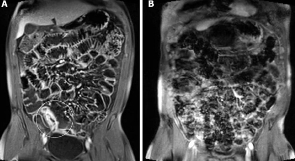 МРТ кишечника - снимки