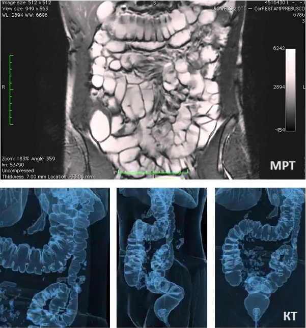 Отличия снимков кишечника на КТ и МРТ
