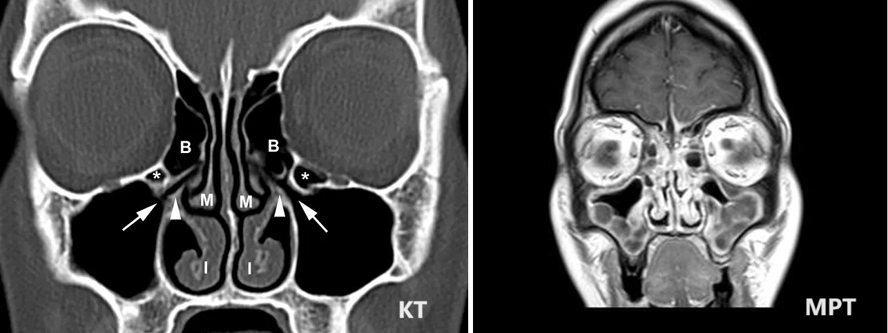Сравнение КТ и МРТ пазух носа - снимки