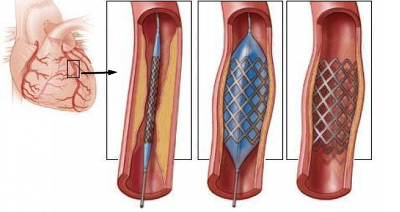 Стенты и шунты в сосудах сердца