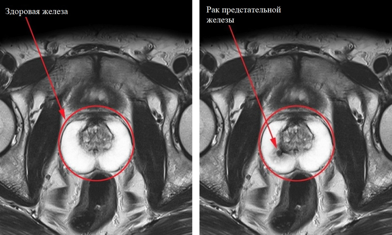 Сравнение МРТ здоровой простаты и рака предстательной железы