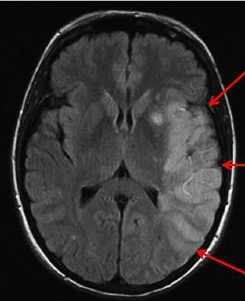 МРТ головного мозга ребенку при сотрясении - что показывают снимки