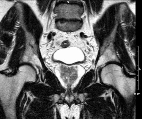 МРТ простаты - снимки с контрастом