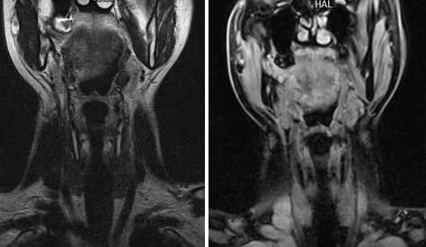МРТ щитовидной железы - снимки